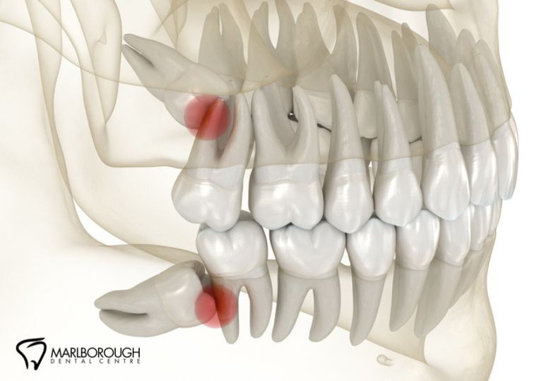 Do I Need Wisdom Teeth Removal? Signs and Indications to Consider